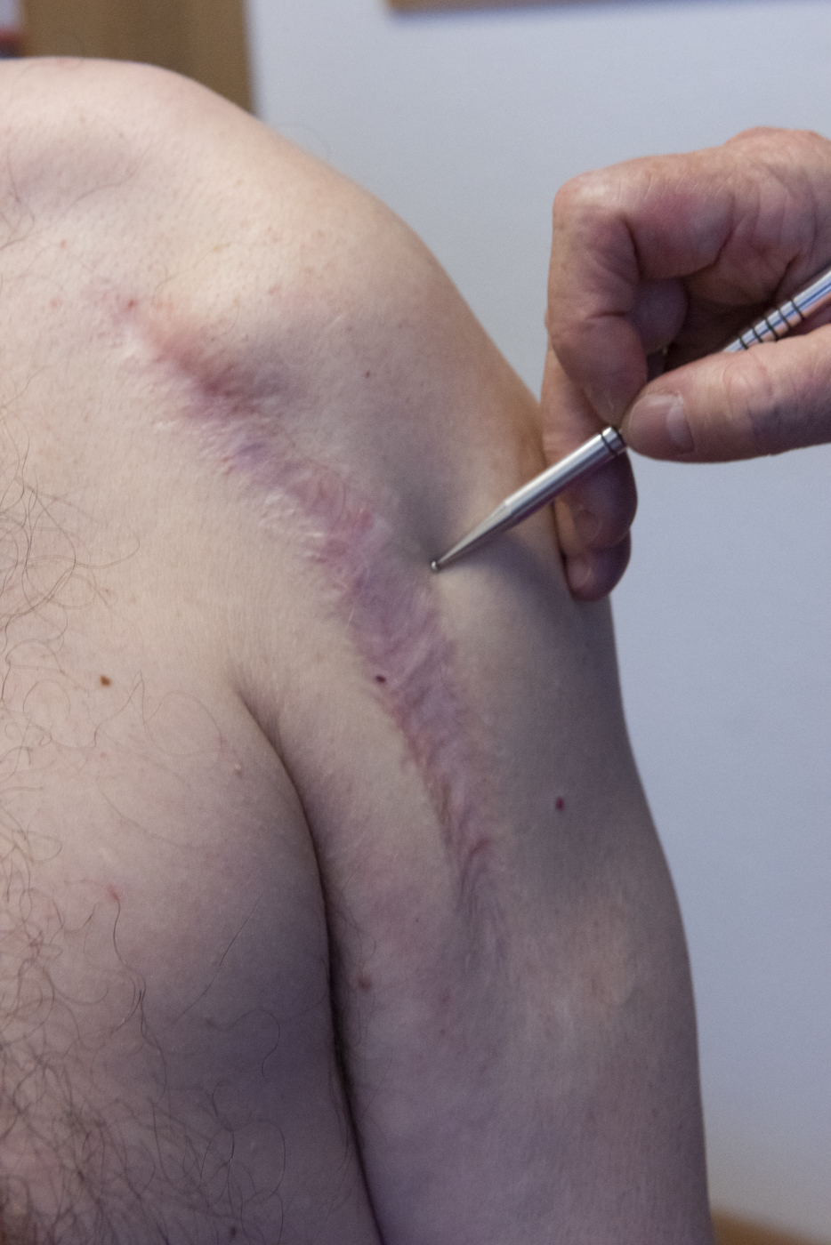 Cicatrici braccio Fisioterapia Coldesina